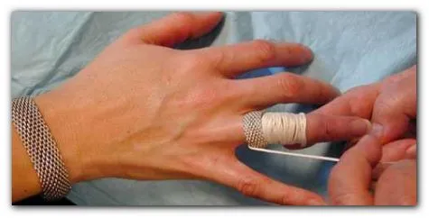 Использование нитей для снятие кольца с опухшего пальца